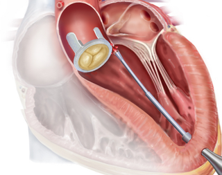 Illustration of robotic catheter navigation to the site of the leaking prosthetic valve.